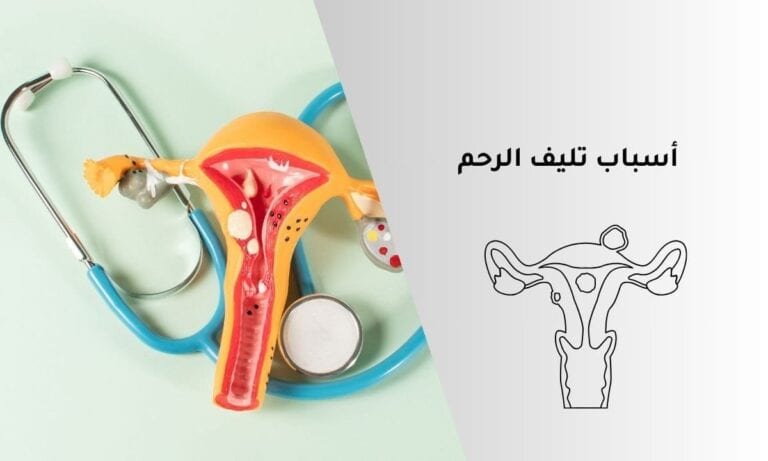 أسباب تليف الرحم