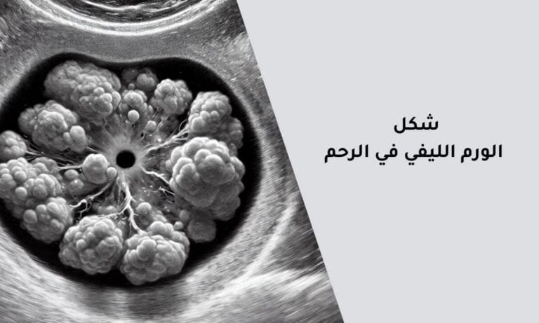 شكل الورم الليفي في الرحم