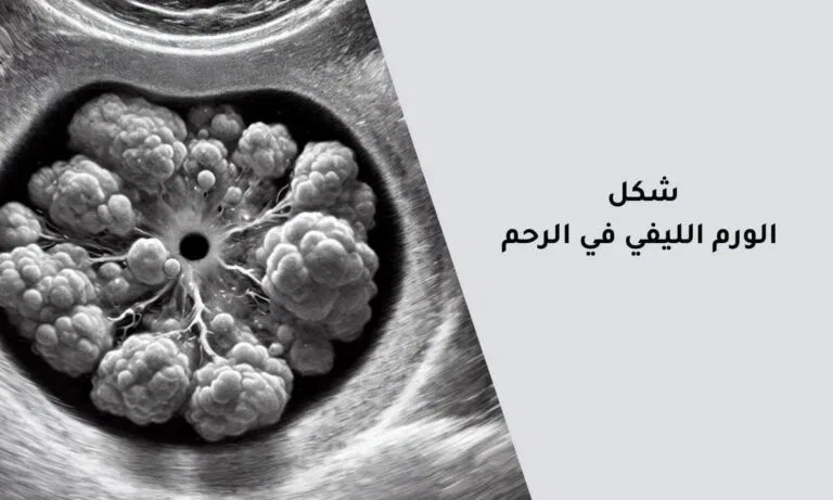 شكل الورم الليفي في الرحم