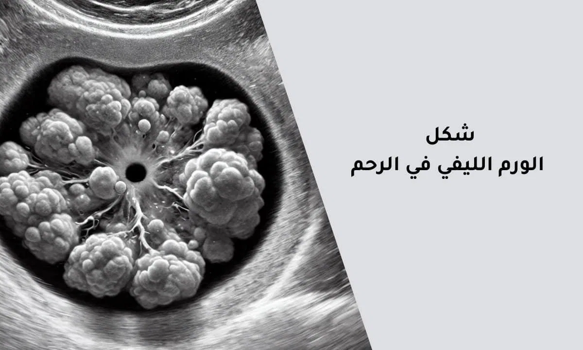 شكل الورم الليفي في الرحم